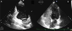 Transthoracic echocardiogram. A) Two-chamber view showing a congenital left ventricular outpouching in the inferobasal wall. B) Right-to-left shunt was demonstrated by the passage of bubbles after the injection of agitated saline solution.