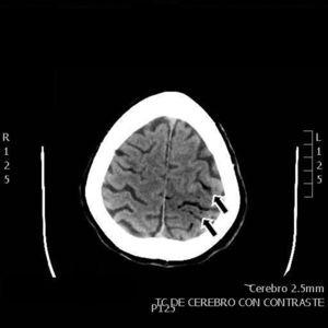 Cranial CT: serpiginous images compatible with air bubbles in the left parietal area (arrows).