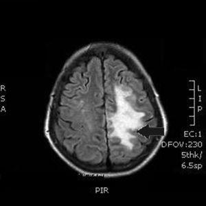 Brain MRI at 48hours: areas of restricted diffusion suggestive of ischaemic lesions in the left and middle cerebral artery territories (arrow).