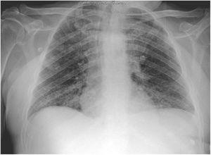 Chest radiography of the second patient showing interstitial infiltrate in the lung base bilaterally, suggestive of SARS-CoV-2 infection.