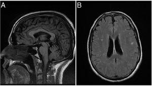 Brain magnetic resonance imaging study: (A) T1-weighted sequence showing superior cerebellar vermis atrophy. (B) T2-weighted FLAIR sequence showing hyperintensities.