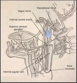 Diagram showing the relationships between the vagus and hypoglossal nerves in the poststyloid space.