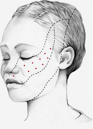 Infiltration into the V2 territory in patients with trigeminal neuralgia. The area of injection may include trigger points inside the oral cavity. OnabotA injection into some sites in the contralateral side should also be considered to reduce the risk of facial asymmetry.