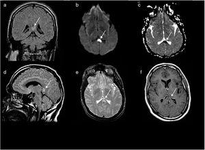 Baseline brain MR images obtained in a 1T MRI scanner: coronal (A) and sagittal (D) 2D T2-weighted FLAIR pulse sequences; axial EPI-DWI sequence (b = 1000 s/mm2) (B); axial T2-weighted FSE sequence (E); post-contrast axial T1-weighted FSE sequence (F); and axial greyscale ADC map (C). Signal alterations are observed in the left central and lateral splenium (white arrow), with restricted diffusion and no contrast enhancement. These findings are compatible with cytotoxic oedema. No alterations were observed in the rest of the corpus callosum (D) or in any other part of the brain parenchyma.