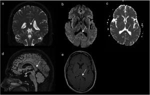 Follow-up MR images obtained 17 days later in a 1.5T scanner: coronal T2-weighted FSE sequence (A); axial EPI-DWI sequence (b = 1000 s/mm2) (B); sagittal 3D-FSE Cube FLAIR sequence (D); post-contrast axial T1-weighted FSE sequence (E); axial greyscale ADC map (C). The images show complete resolution of the cytotoxic oedema in the splenium (white arrows) and no lesions in the rest of the brain parenchyma.