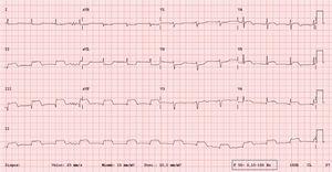 ECG revealing a pronounced ST segment elevation in the inferior (leads II, III, and aVF) and anterolateral sides (V4, V5, and V6), corresponding to a subepicardial lesion involving these regions.