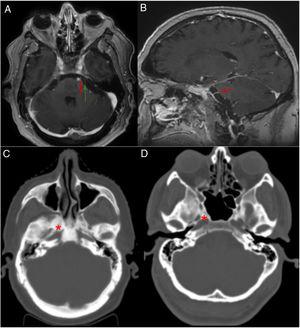 A and B) Brain MRI. Contrast T1-weighted sequences: A) axial plane; B) sagittal plane. Red arrow: the left abducens nerve, emerging from the prepontine cistern, shows increased contrast uptake, probably due to involvement of the Dorello canal. Green arrow: trigeminal nerve, with no contrast uptake. C and D) Head CT scan (bone window), axial plane. C) Diffuse hyperdensities in the clivus and sphenoid bone (red asterisk), suggesting bone metastases. D) Image from a control, showing no hyperdensities at the base of the skull.