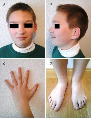 A and B) Facial features: blepharophimosis, ptosis, hypertelorism, bulbous nose, and mild retrognathia. C) Limitations in thumb abduction. D) Long toes in both feet.