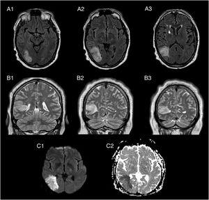 Brain MRI: FLAIR sequences, axial plane (A1-A3); T2-weighted sequences, coronal plane (B1-B3); diffusion-weighted sequences, axial plane (C1 = tDWI, C2 = ADC). The images reveal a hyperintense cortical-subcortical lesion in the right temporal lobe on T2-weighted and FLAIR sequences (A1-B3), involving the right middle and inferior temporal gyri and extending to the ipsilateral peritrigonal region and occipital horn of the lateral ventricle. Hyperintensity in diffusion-weighted sequence (C1), with low signal in the ADC map (C2).