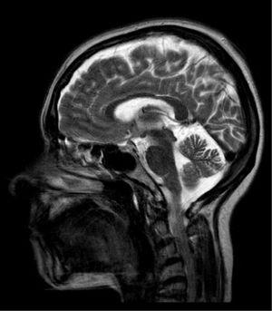 Brain T2-weighted MRI scan, sagittal plane, showing mild cerebellar atrophy for the patient's age.