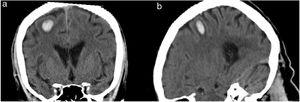 Kopf-CT-Scan. Koronale (a) und sagittale Ebenen (b) zeigen ein kleines intraparenchymales Hämatom im rechten präfrontalen Gyrus mit einem leichten Ödem in der Umgebung.