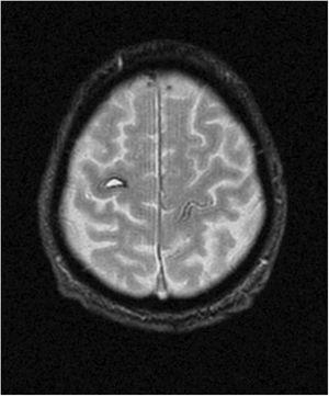 T2-weighted brain MRI scan (axial plane); the right precentral gyrus shows a crescent-shaped hyperintense lesion surrounded by a halo of haemosiderin, compatible with intraparenchymal haematoma.