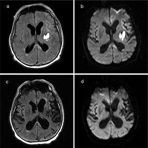 Brain MRI (axial plane). FLAIR (a) and diffusion-weighted sequences (b) reveal a lesion to the splenium of the corpus callosum, predominantly on the left side. The study performed 35 days later (c and d) reveals nearly complete resolution of the lesion.