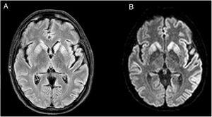 Brain MRI. (A) FLAIR sequence showing hyperintensity in both caudate nuclei. (B) DWI sequence showing diffusion restriction in the putamina and caudate nuclei, frontal and temporal parasagittal areas, and both cingulate gyri, with left predominance.