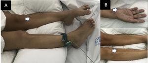 Muscle atrophy in the tibialis anterior (A) and abductor digiti minimi (B).