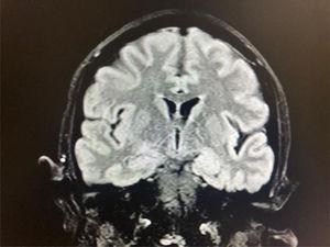 Coronal T2-weighted FLAIR sequence showing hyperintensities in the left hippocampus.