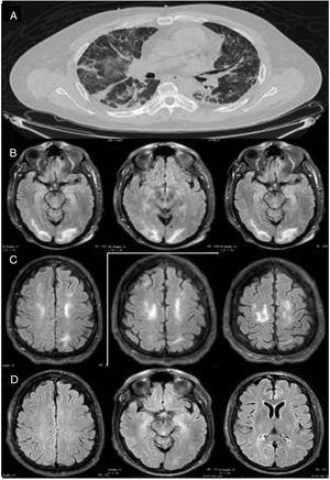 Imaging studies of our patient. (A) Chest CT (axial plane) showing multiple areas of ground-glass opacification in both lungs. (B) Brain MRI scan (axial plane) showing subcortical and white matter hyperintensities in the occipital lobes. (C) T2-weighted FLAIR brain MRI scan (axial plane) showing white matter hyperintensities in both frontal lobes. (D) Follow-up MRI scan performed 15 days later, revealing complete disappearance of hyperintensities in the frontal and occipital lobes.