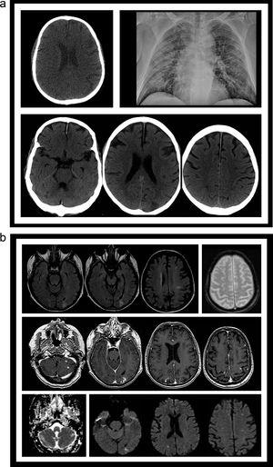 (a) CT image (A) from PET/CT scan evaluation for the light-chain disease showing no abnormality ten days before the onset of fever. Chest RX (B) showing bilateral lung infiltrates. Different slices from head CT (C) obtained after the patient developed neurological symptoms demonstrating several low attenuating lesions (arrows), both cortical and white matter locations. (b) Different sequences from a MRI study obtained a week after the start of the neurological symptoms. FLAIR slices (A), gradient-echo (B), postgadolinium injection 3D FSPGR T1-weighted slices (C), ADC map (D) and diffusion-weighted slices, showing several subacute small infarcts (arrows), with high signal in both T2 and DWI images, contrast enhancement, and decreased ADC values in some of them.