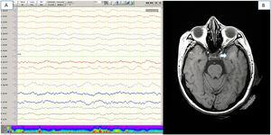 Complementary tests (patient 16). (A) Waking electroencephalography trace showing diffuse slowing. (B) Brain MRI (FLAIR sequence) showing white matter focal hyperintensity in the left temporal lobe.