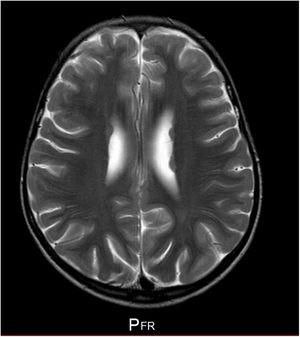 Brain magnetic resonance imaging sequence study performed when the patient was 5 years old. Axial T2-weighted sequence. Periventricular heterotopia.