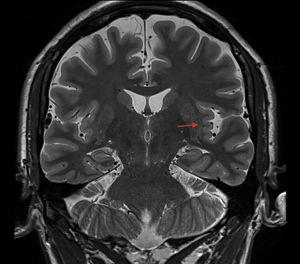 T2-weighted brain MRI sequence (coronal plane) showing prominence of the left Sylvian fissure and polymicrogyria of the left insular cortex.
