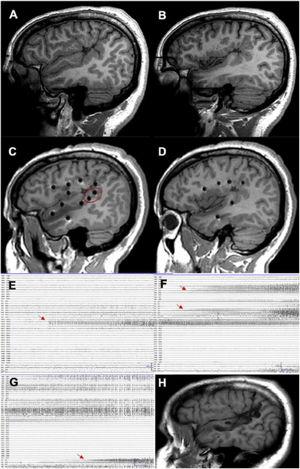 A patient with focal epilepsy associated with extensive right perisylvian polymicrogyria. A and B) Sagittal T1-weighted sequence showing the extension of the malformation, with involvement of deep areas of the insula and operculum. C and D) Extensive implantation of depth electrodes enabling exploration of the cortex on different planes, including the insula. E) Seizure onset occurred in the posterior part of the superior temporal gyrus (circle in C). F) Progression to the temporal cortex and posterior insula. G) Progression to the hippocampus. H) Sagittal T1-weighted sequence showing how resection limited to the superior temporal gyrus was able to control this patient’s epilepsy, despite the extensive lesion.