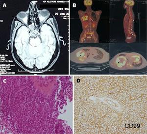 A) Axial T1-weighted brain MRI scan showing a tumour in the clivus. B) 18F-FDG PET study revealing a hypermetabolic mass in the right lung, with nodules in the left lower lobe (stars) and diffuse bone metastases (arrows). C) Round cell tumour proliferation. The histological study revealed cells with ill-defined cytoplasm and hyperchromatic nuclei (although most cells were non-nucleated), and abnormal mitosis. D) The immunohistochemical study revealed positivity for anti-CD99 antibodies.