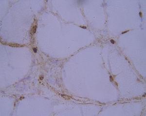 Immunohistochemical study of the membrane attack complex: C5b9 deposition in endomysial capillaries.