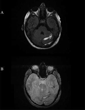 Brain MRI: FLAIR (A) and gradient-echo (B) sequences revealing areas of oedema, ischaemia, and haemorrhagic transformation in the left parietal region and cerebellum.