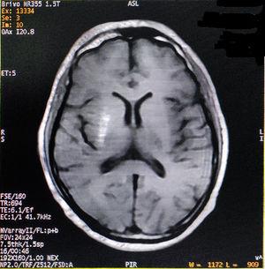 Axial T1-weighted image showing hyperintense lesion in right striatum.