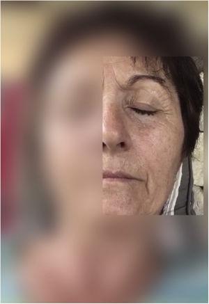 Symptoms of our patient: left hemifacial spasm, with elevation of the left eyebrow and mild twitching of the orbicularis oculi, levator anguli oris, and mentalis muscles, resulting in mild facial asymmetry.