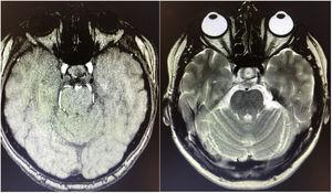 Brain MRI (axial plane). T1-weighted contrast-enhanced (left) and T2-weighted sequences (right) at the level of the pons, revealing no arteriovenous malformations or other structural lesions at the cerebellopontine angle.