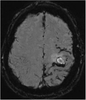 Susceptibility-weighted imaging brain MRI sequence, axial plane. Numerous punctiform haemorrhagic foci are observed in the parietal lobe, with fewer foci in the posterior frontal lobe and only isolated foci in the occipital lobe, all in the left hemisphere. A fine hypodense rim is present in the subarachnoid space at the level of the Rolandic fissure, indicating leptomeningeal siderosis.