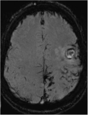 Susceptibility-weighted imaging brain MRI sequence, axial plane, showing persistence of the haemosiderin deposits in the left parietal, posterior frontal, and occipital lobes and the fine subarachnoid rim suggestive of leptomeningeal siderosis. No haemosiderin deposition is visible in the right hemisphere.