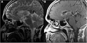 Brain MRI scan. A) Sagittal T2-weighted fast spin-echo sequence showing a smaller-than-normal pituitary gland for the patient’s age. The image also shows cotton wool–like periventricular signal hyperintensity in the genu and body of the corpus callosum. B) Sagittal T1-weighted fast spin-echo post-contrast sequence showing pseudonodular contrast uptake in the ependyma of the frontal horns, extending to the corpus callosum, coinciding with the signal alteration observed on T2-weighted sequences, and smooth contrast uptake in the fourth ventricle and upper part of the pituitary stalk. No lesion or pathological contrast uptake was observed in the pineal gland.