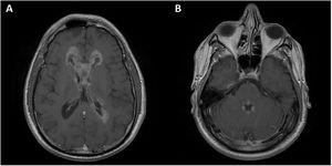 Brain MRI scan. Axial T1-weighted fast spin-echo post-contrast sequence showing a marked increase in the size and extension of ependymal enhancement in the lateral ventricles (A) and the fourth ventricle (B).