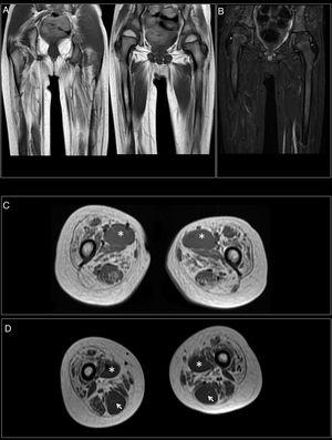 Muscle MRI. (A) Coronal T1-weighted sequence showing fatty replacement of the proximal muscles of both lower limbs; involvement is symmetrical and bilateral. (B) T2-weighted sequences showed no signs of acute denervation. (C) Symmetrical fatty replacement, with particular involvement of the anterior (quadriceps) and medial (adductor magnus) compartments. The adductor longus is preserved (asterisk). (D) Partial fatty replacement of the ischiotibial muscles in the posterior compartment, with the exception of the semitendinosus (arrow).