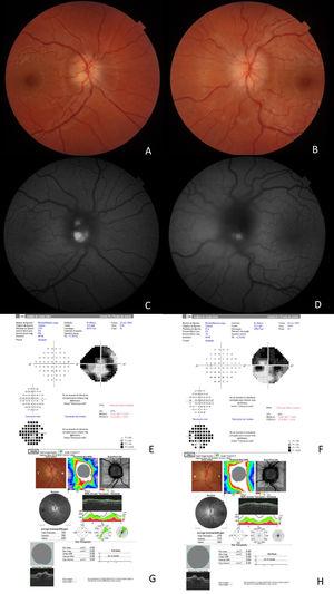 (A) Optic disc oedema in the right eye. (B) Optic disc oedema in the left eye. (C) Autofluorescence study: hyperfluorescence indicates presence of drusen in the right eye. (D) Autofluorescence study: hyperfluorescence indicates presence of drusen in the left eye. (E) The visual field of the right eye shows marked visual field constriction. (F) The visual field of the left eye shows marked visual field constriction. (G) OCT of the right eye reveals increased retinal nerve fibre layer thickness. (H) OCT of the left eye reveals increased retinal nerve fibre layer thickness.