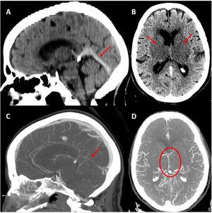 Baseline head CT scan. A) Hyperdensity of the straight sinus. B) Bilateral capsuloganglionic and thalamic infarcts. Contrast-enhanced CT angiography, venous phase. C) Lack of opacification of the straight sinus. D) Poor opacification of the deep venous system, predominantly on the left side.