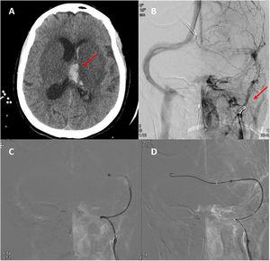 A) Second head CT scan, showing haemorrhagic transformation of the left thalamic infarct. B) Neuroangiography study showing irregular opacification of the left internal jugular vein and lack of opacification of the distal ipsilateral venous system. C and D) Neuroangiography study showing the passage of the guidewire and thrombectomy catheter from the right to the left transverse sinus across the torcular Herophili.