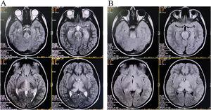 Axial T2-weighted (A) and FLAIR-weighted (B) images revealing bilateral symmetrical hyperintense lesions involving thalami and brainstem (some motion-related artifacts can be noted, as the patient was moving involuntarily during imaging procedure.