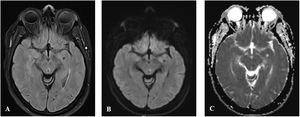 Brain MRI study (axial plane) showing a paramedian mesencephalic lesion, displaying signal hyperintensity on FLAIR (A) and B100 sequences (B), and hypointensity on the ADC map (C).