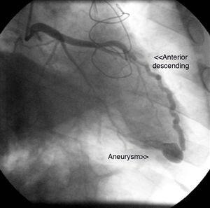 Coronary angiogram two years after heart transplantation showing a small fistula from the distal anterior descending artery to the right ventricle with an associated aneurysm.
