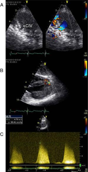 Transthoracic echocardiogram two years after heart transplantation showing two solutions of continuity (A and B) with two high-velocity jets (maximum 5m/s) (C) from the left to the right ventricle, located in the apical and mid segments of the interventricular septum, that appear to be two restrictive interventricular communications. CIV: interventricular communication.