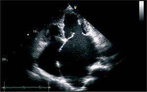 Idiopathic biatrial dilatation characterized by multimodality imaging ...