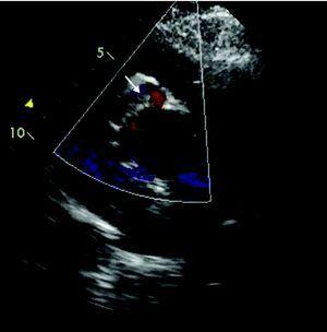Left parasternal short-axis echocardiogram at the level of the aorta, showing a tubular structure (arrow) encircling the aorta.