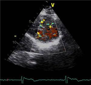 Left parasternal short-axis view, with color Doppler showing blood flow within the trabecular recesses of the apex.