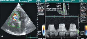 (A) Doppler echocardiography revealing severely dilated atria and aliasing/turbulence of right ventricular inflow; (B) continuous Doppler showing mean tricuspid valve gradient of 9.5mmHg.