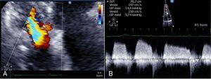 (A) Doppler echocardiogram showing aliasing/turbulence of right ventricular inflow; (B) continuous Doppler showing mean tricuspid valve gradient of 10mmHg.