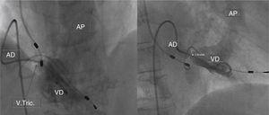 Right heart catheterization revealing malpositioning of the pacemaker lead at the level of the tricuspid valve, which is deformed, with limited opening.